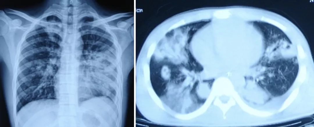 金葡菌感染肺炎能自愈吗,流感病毒诊断的金标准