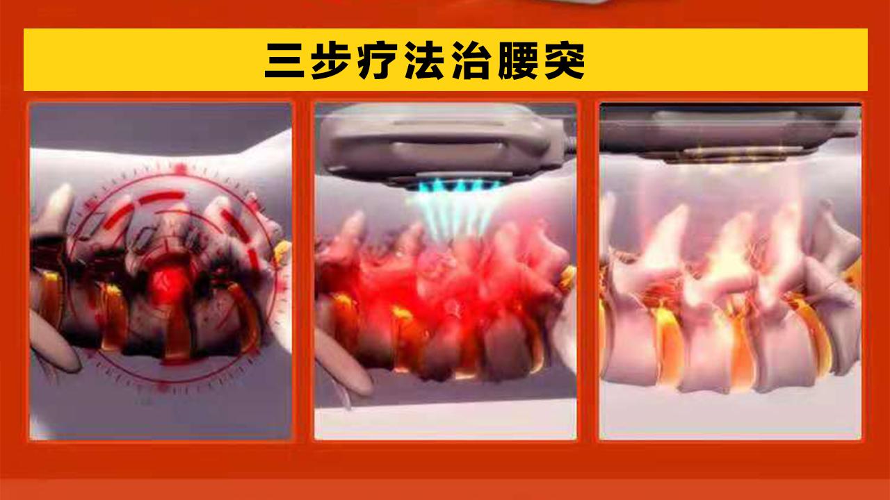 广告铁腰板真的能把腰突治好吗,铁腰板治疗效果图