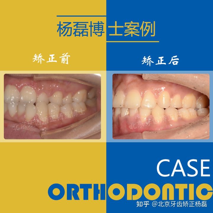 北京牙齿矫正大约要多少钱,北京哪个医院看牙齿矫正比较好
