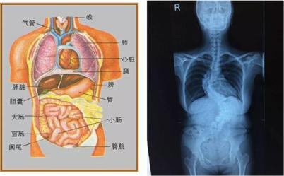18岁少女脊柱严重侧弯元凶,16岁女童脊柱侧弯