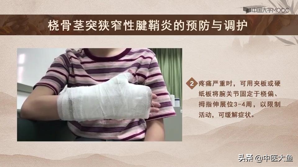 桡骨茎突狭窄性腱鞘炎怎么治疗,桡骨茎突狭窄性腱鞘炎治疗方法