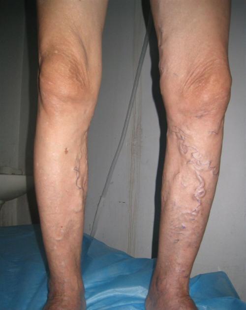 二郎腿引起静脉曲张,二郎腿会导致静脉曲张吗