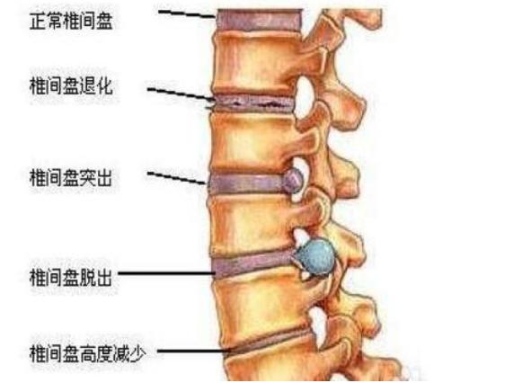 腰椎间盘突出脚肌肉萎缩怎么恢复,腰椎间盘突出会导致腿部肌肉萎缩
