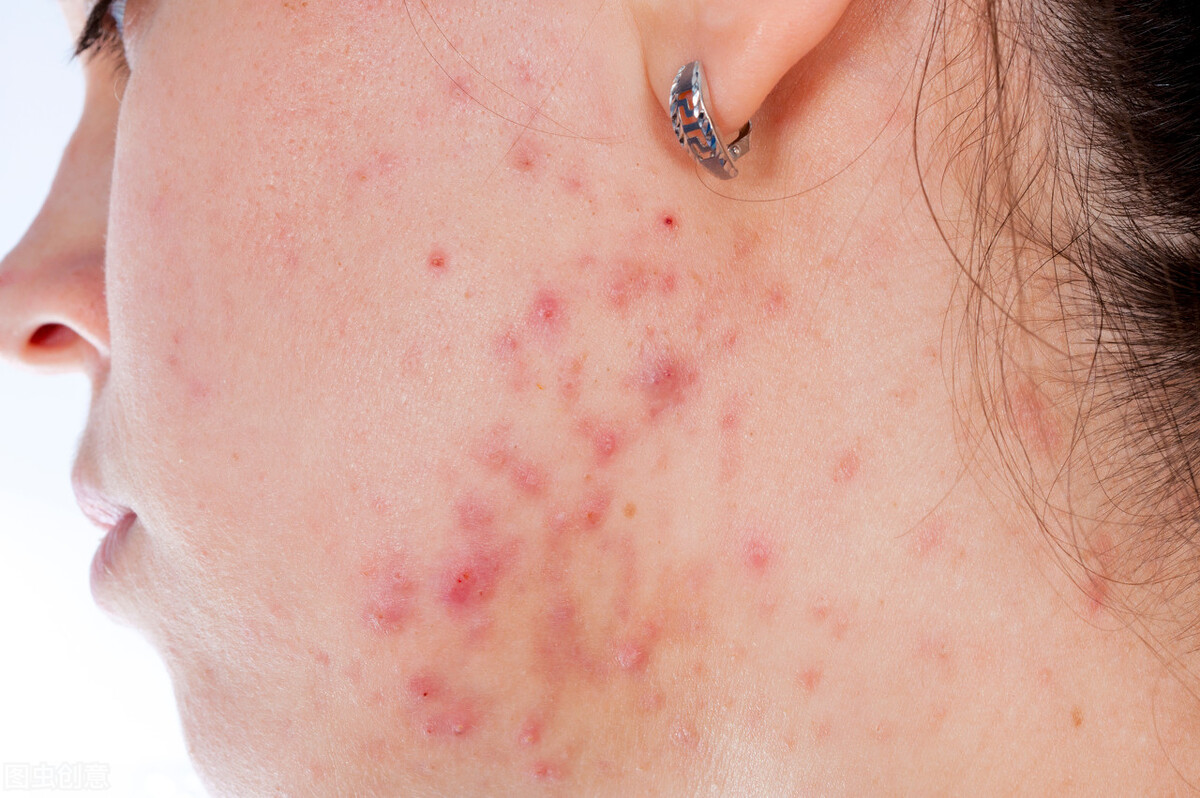 长疮怎么处理表面,长了疮怎么办