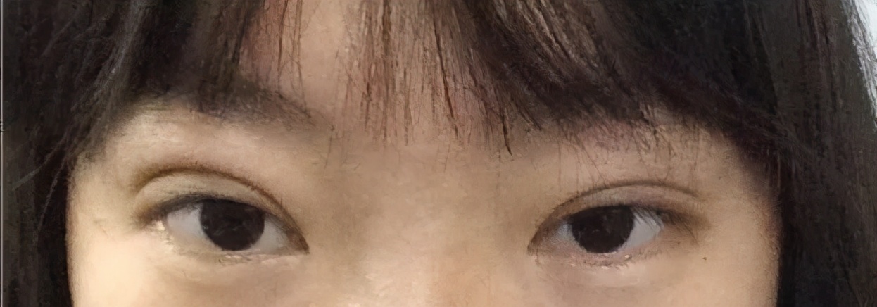 双眼皮整形修复,潘贰双眼皮修复