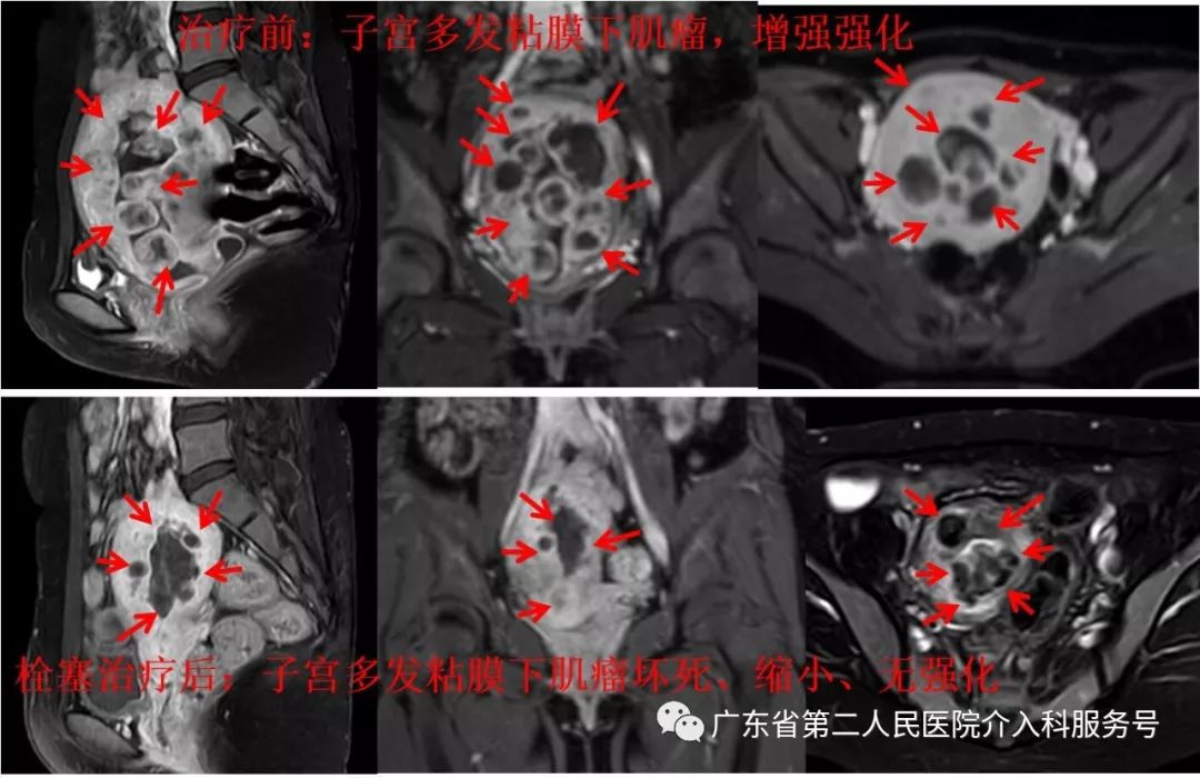子宫肌瘤引起月经量多贫血怎么办,子宫多发肌瘤月经量多怎样治疗