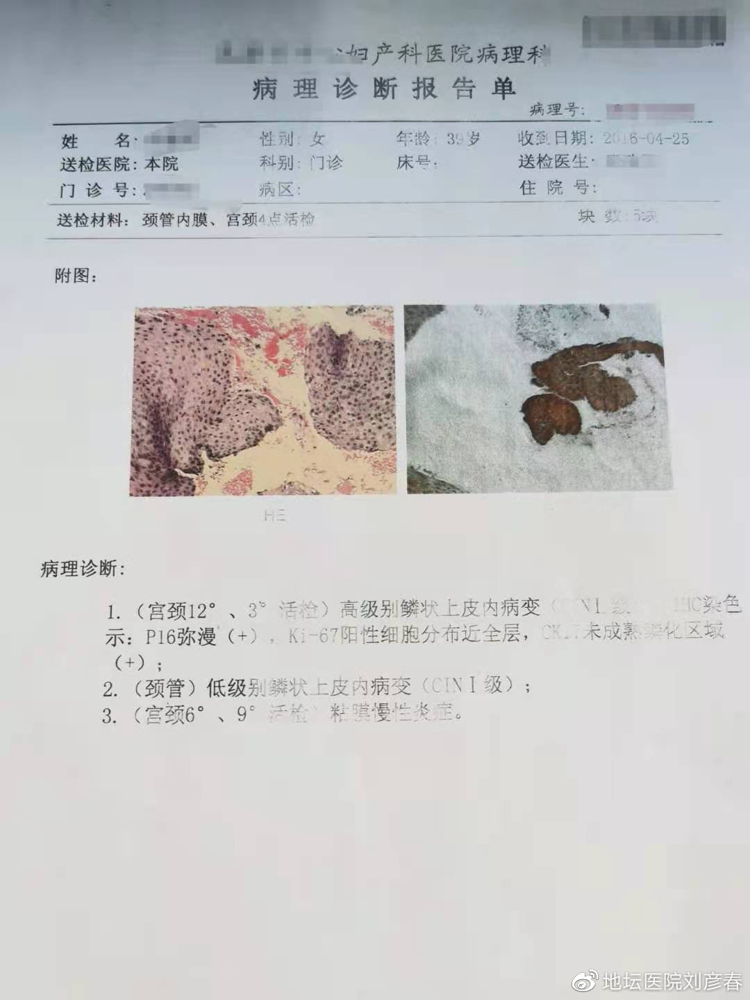 外阴及肛周瘙痒是感染hpv病毒吗,hpv感染外阴瘙痒腰骶酸痛是癌吗