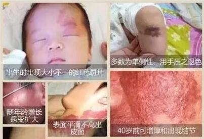 鲜红斑痣会遗传给下一代吗,母亲有鲜红斑痣会遗传给孩子吗