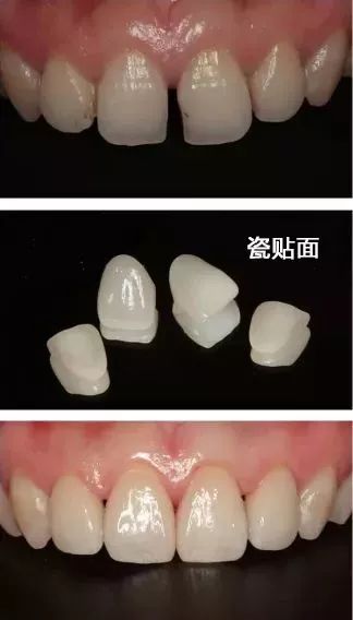 吃东西塞牙很严重怎么办,牙缝太大总塞牙导致牙疼