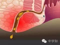男性肛周潮湿是啥病,外痔引起的肛周潮湿