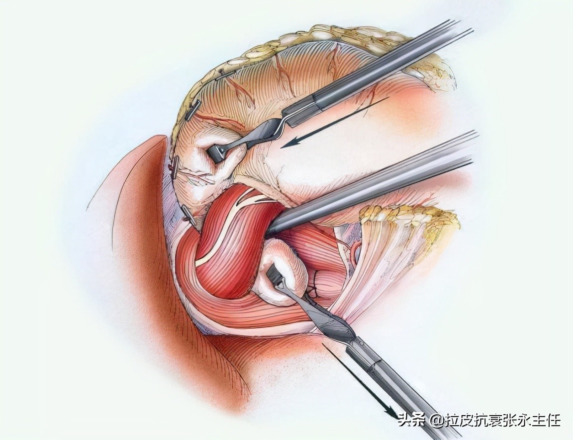 内窥镜除皱和小切口除皱,内窥镜除皱术真实案例