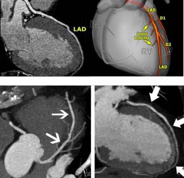 冠脉ct造影,冠脉ct检查轻微狭窄还用做造影吗