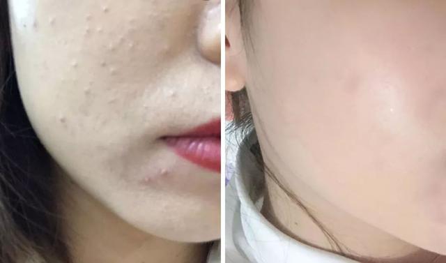 闭口粉刺怎么导致的,闭口粉刺和闭口的区别