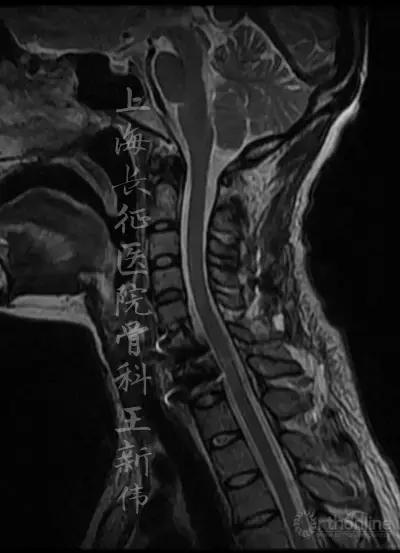 颈椎外伤受损如何治疗,颈椎损伤手术恢复怎么样