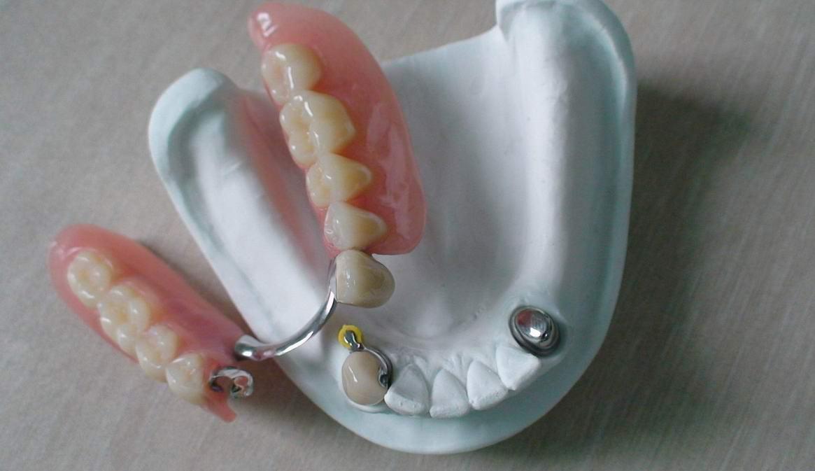 拔牙都有哪几颗牙可以拔,拔牙后多久可以拔另一侧牙