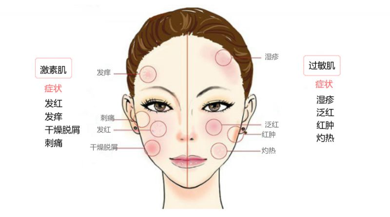 怎么区分激素脸和过敏脸,过敏脸与激素脸的区别