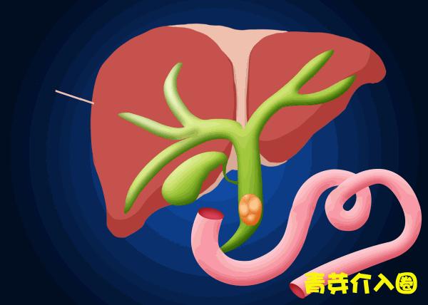 胆道阻塞眼睛发黄图片,胆管堵塞全身发黄中医治疗