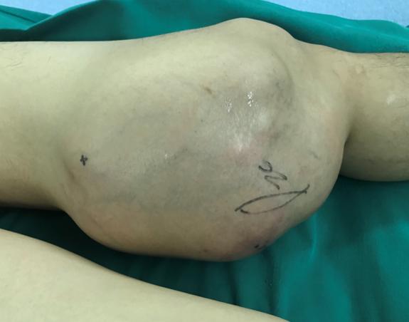 左大腿截肢,左大腿截肢50天为什么残肢还肿胀