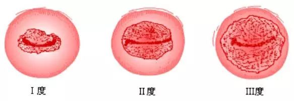 宫颈上环避孕,备孕宫颈糜烂需要用保妇康栓吗