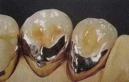 如何挑选烤瓷牙材料,怎样选择适合你的烤瓷牙