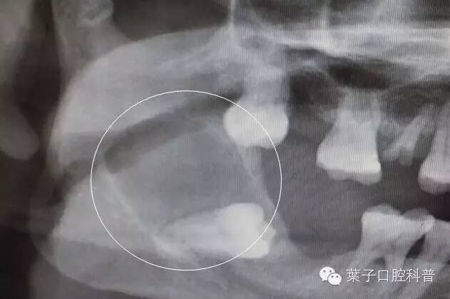 拔智齿：讳疾忌医有什么后果？#葉子口腔科普#