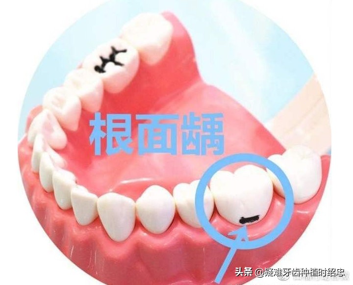 牙齿从根部烂掉什么原因,牙齿从根部往里烂掉怎么回事