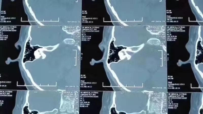 大前庭治疗的最新科技,大前庭什么时候能治