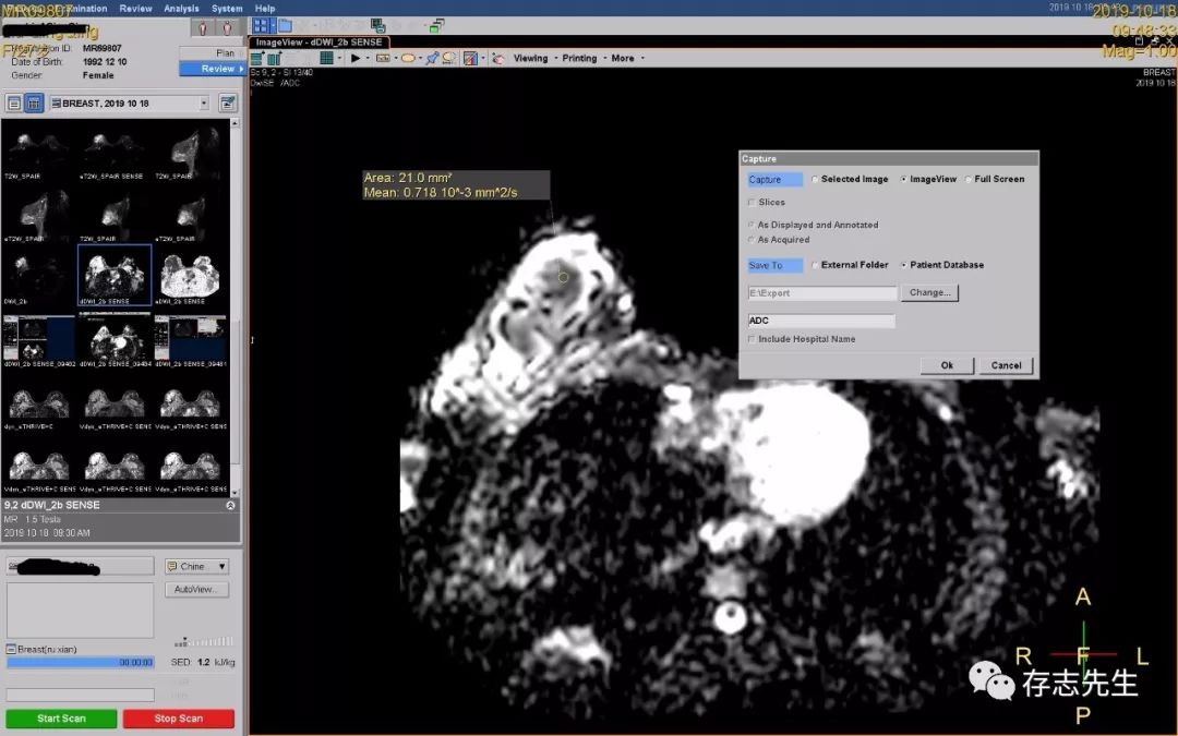 乳腺磁共振亲身经历,磁共振乳腺动态增强扫描全过程