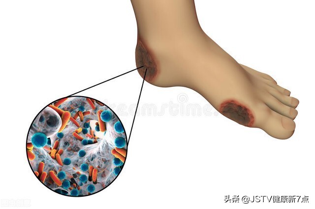 92岁老人右足坏疽太危险，多学科联合救治解难题，专家提醒：糖尿病足病贵在早防早治