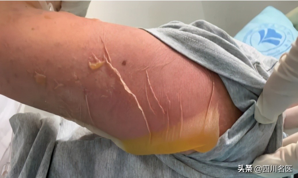 发烧引起皮肤溃烂,发烧过后最里面大面积溃烂