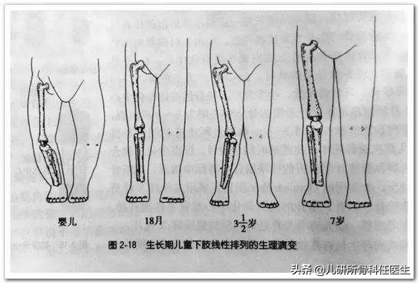 孩子走路太早对腿有什么伤害,宝宝站立早会罗圈腿吗