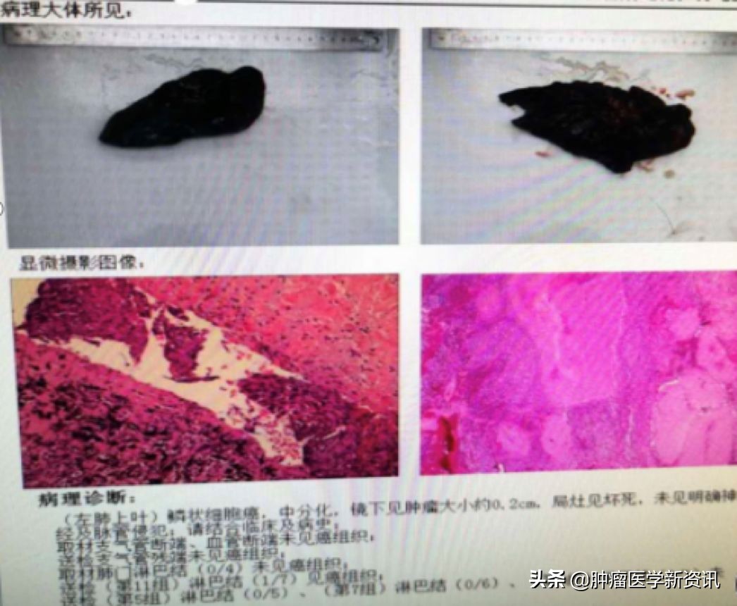 肺癌早期的6个信号中医治癌,肺癌正确的抗癌方法