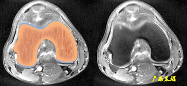 交叉韧带损伤的mr表现,后交叉韧带损伤的诊断实验