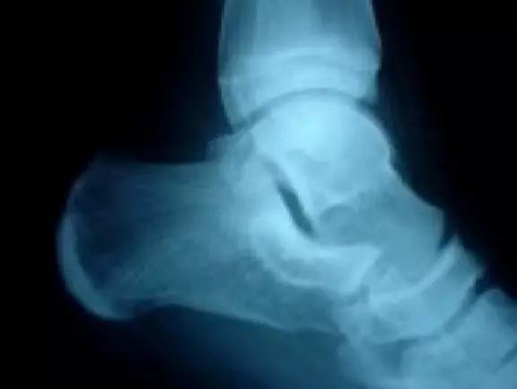 特殊骨折类型,特殊骨折体征