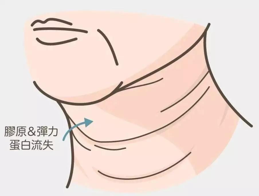 去脖子黑色素颈纹的最快方法,老年人脖子上的颈纹怎么遮挡