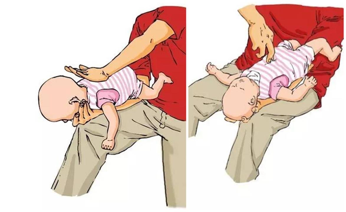 小孩异物卡喉急救方法,孩子异物卡喉急救后未排出没事吗