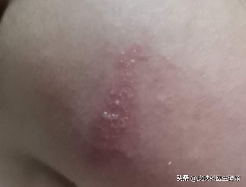 怎么知道隐翅虫皮炎严不严重,怎样能治疗隐翅虫皮炎