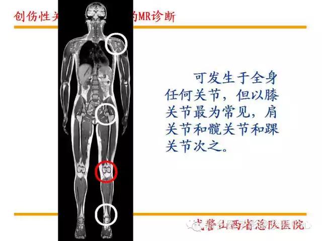 膝关节炎髌上囊积液自己看得出吗,髌上囊有积液膝盖会走路无力吗