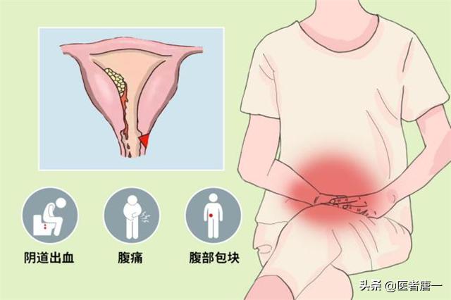 30岁女子不孕查出子宫内膜癌，医生：被误诊一年多，子宫一片黑洞