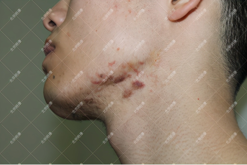 疤康治疤痕疙瘩靠谱吗,瘢痕疙瘩用疤克管用吗