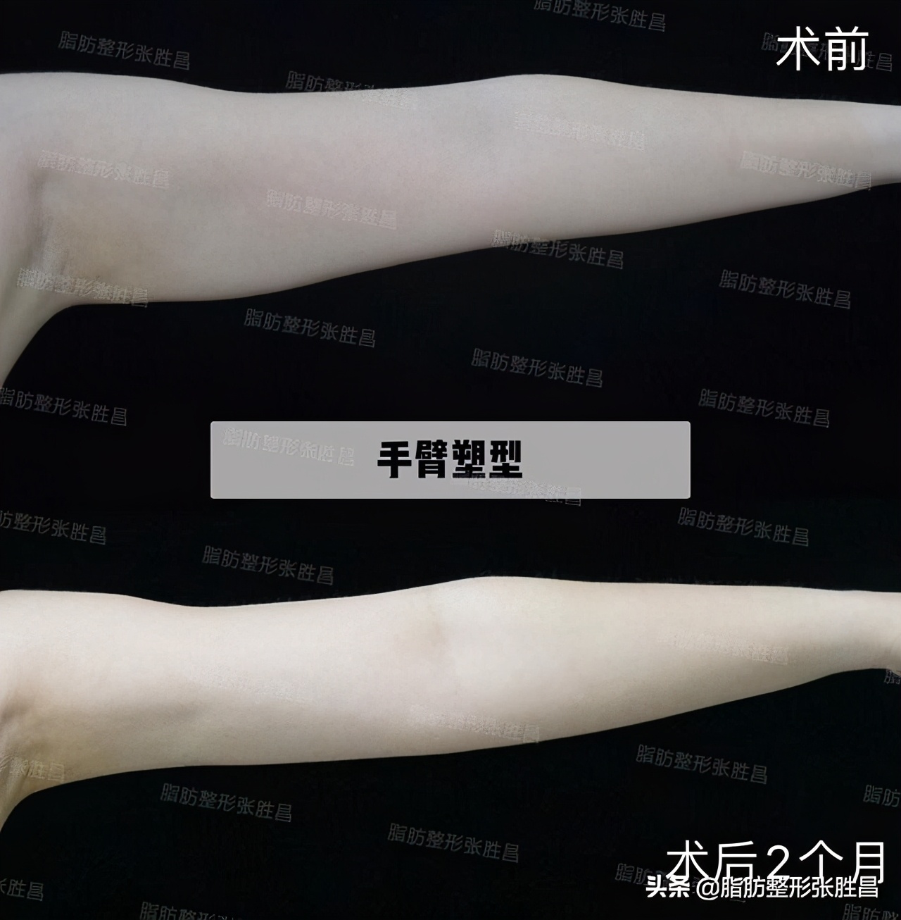 想瘦哪就瘦哪？抽脂才没那么神奇，变美要安全，请别再过度医疗了