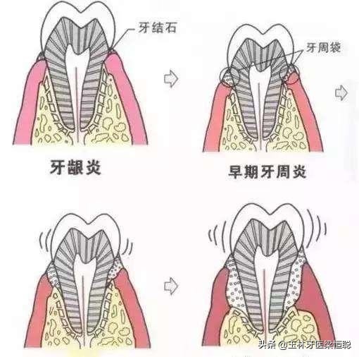 什么是牙周炎的临床表现,什么是牙周炎用什么药见效