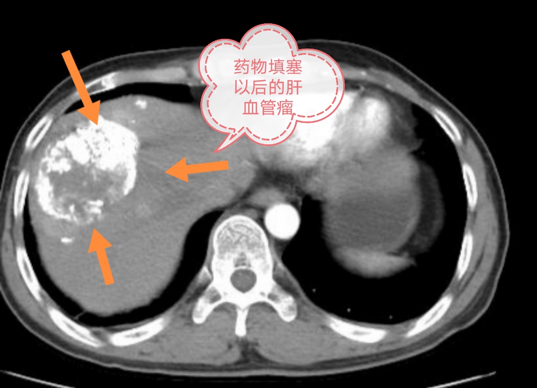 肝血管瘤10公分了介入治疗可以吗,介入治疗肝血管瘤是最好的方案吗