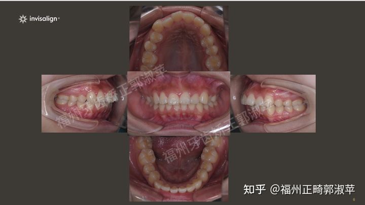 牙齿龅牙矫正过程全记录33岁,大龅牙牙齿矫正成功案例和费用