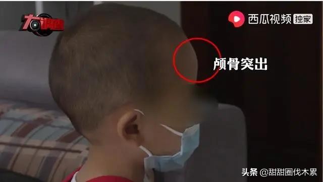 怎么看儿童喝的奶粉合不合适,奶粉导致的大头娃娃可以恢复吗