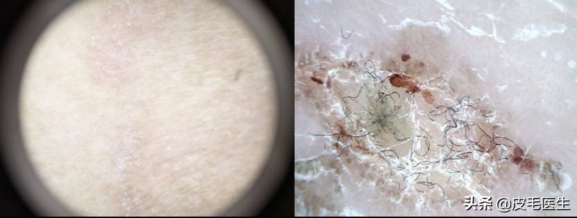 猫狗身上的癣传染人了怎么治,猫狗传染的皮肤病有哪些