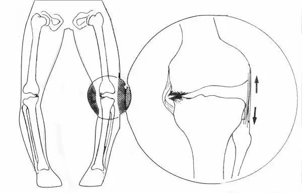 足内翻和踮脚走怎么康复,足内翻会导致什么腿型怎么改
