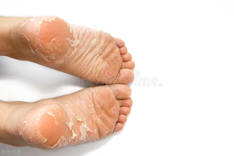 香港脚气脚癣怎么治,脚气怎么治专家现场演示