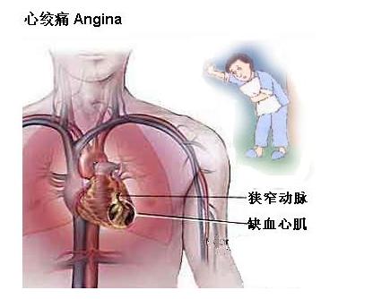 冠状动脉无明显狭窄是什么意思,冠状动脉微循环障碍不稳定心绞痛