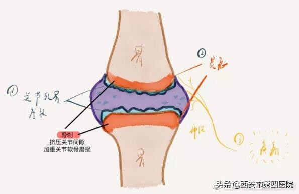 骨头里长刺严重吗,骨头长刺怎么治疗好得快
